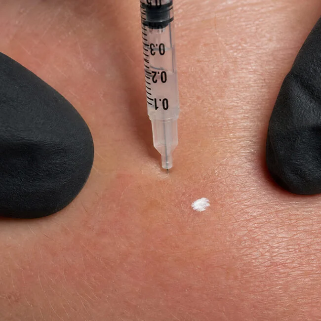 Anti-wrinkle treatment Anti-wrinkle treatment