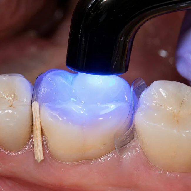 White Fillings White Fillings